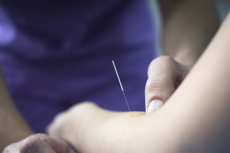 dry needling