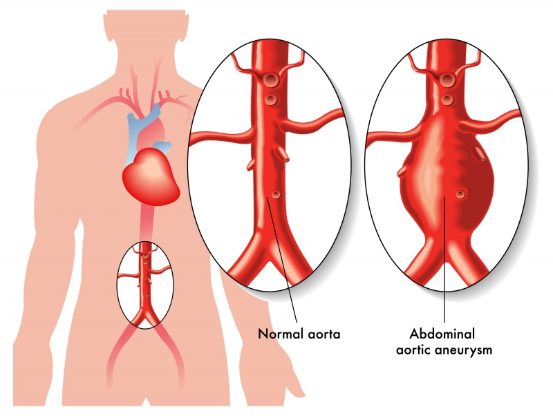 Aneurysma-spurium