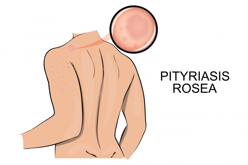Pityriasis-rosea