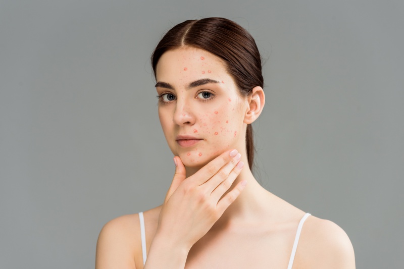 Roaccutane: het medicijn tegen acne
