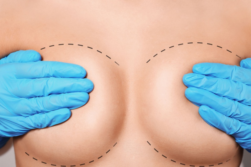 Veilige borstvergroting met implantaten in België
