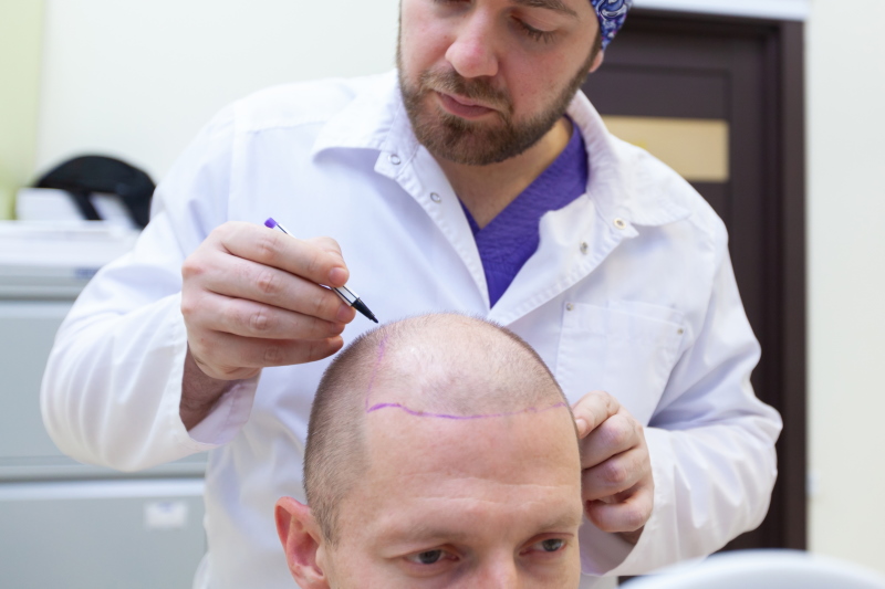 Wat is een haartransplantatie?